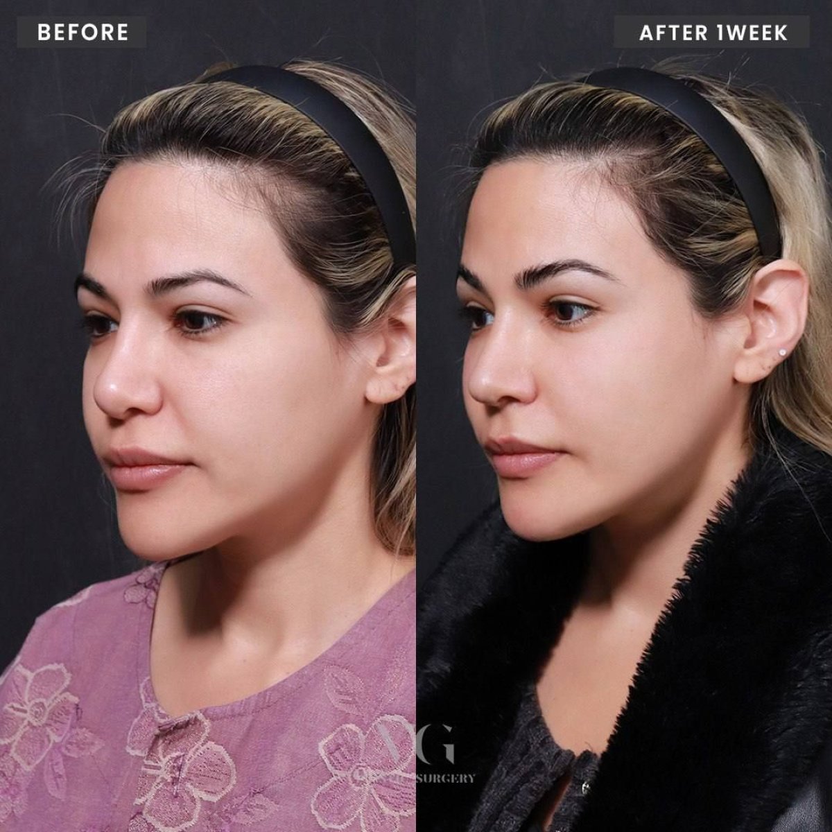Résultats avant et après rhinoplastie secondaire chez VG Plastic Surgery, forme du nez améliorée