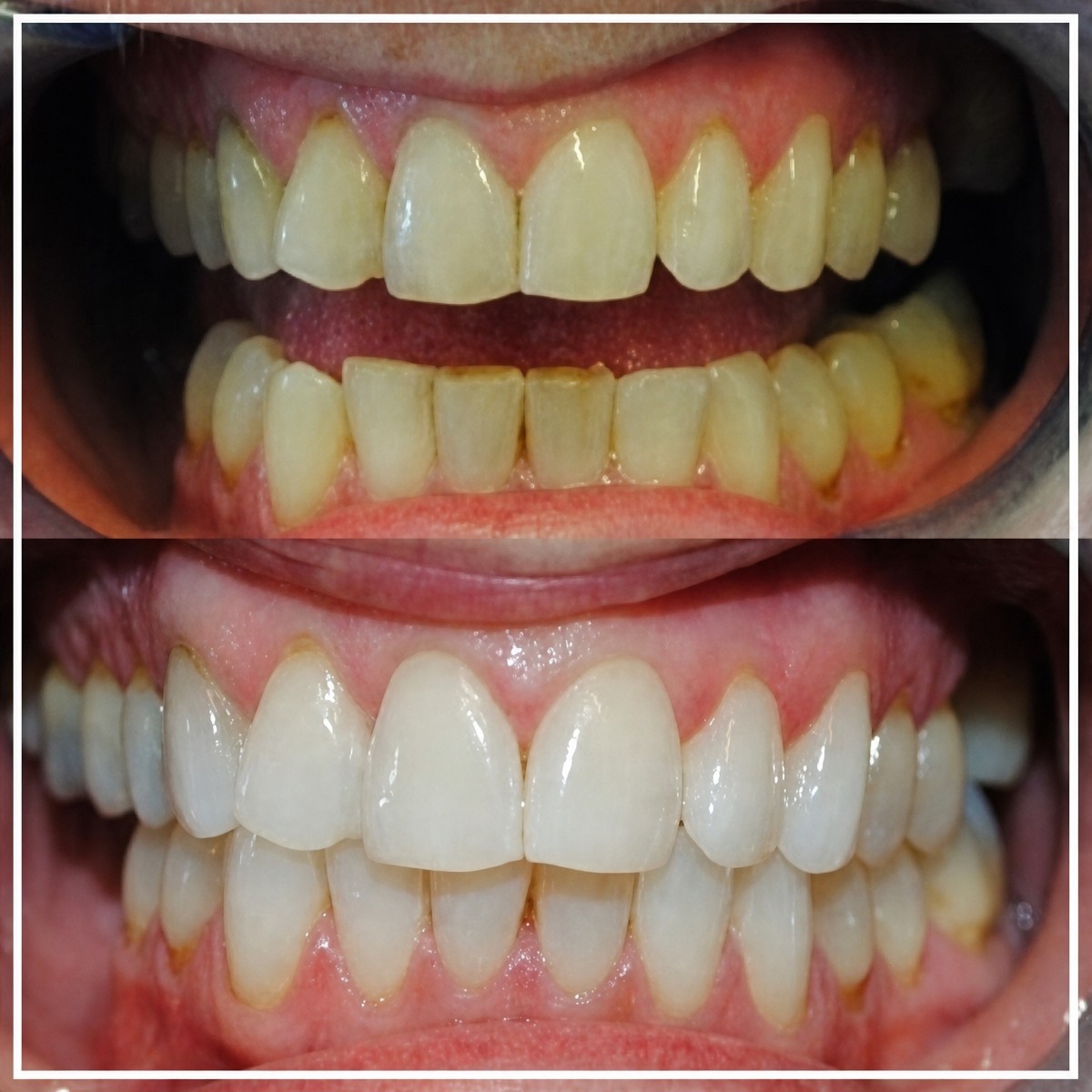 Before and after teeth cleaning (scaling) results at SoftDentalCare Clinic, whiter smile