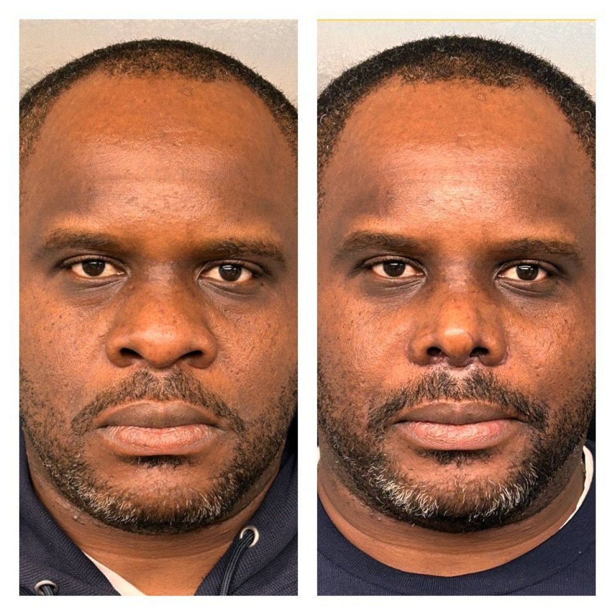 Resultado de rinoplastia de nariz bulbosa antes y después en Memorial Antalya Hospital, forma refinada