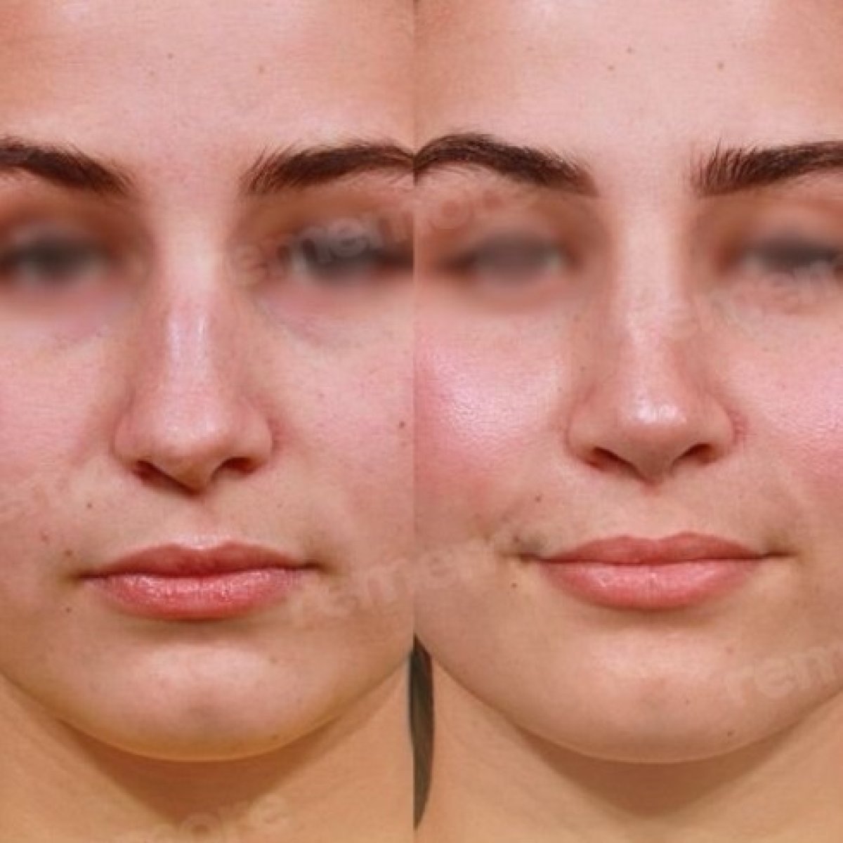 Résultats avant/après rhinoplastie à Memorial Bahçelievler Hospital, remodelage du nez