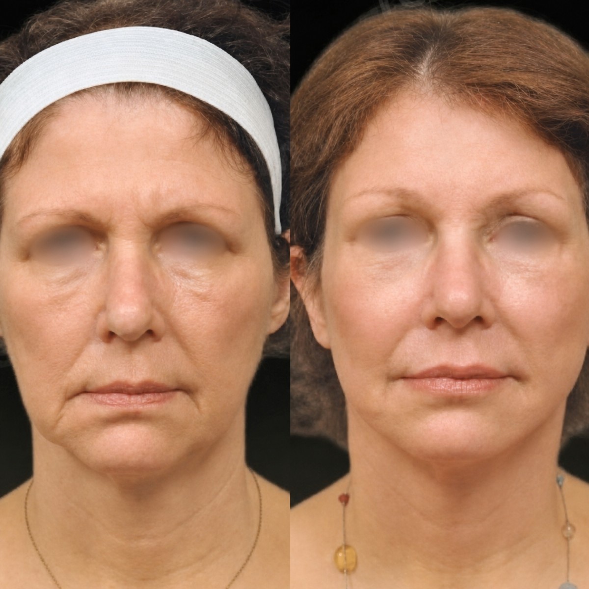 Before and after deep plane facelift results at Memorial Bahçelievler Hospital, facial rejuvenation
