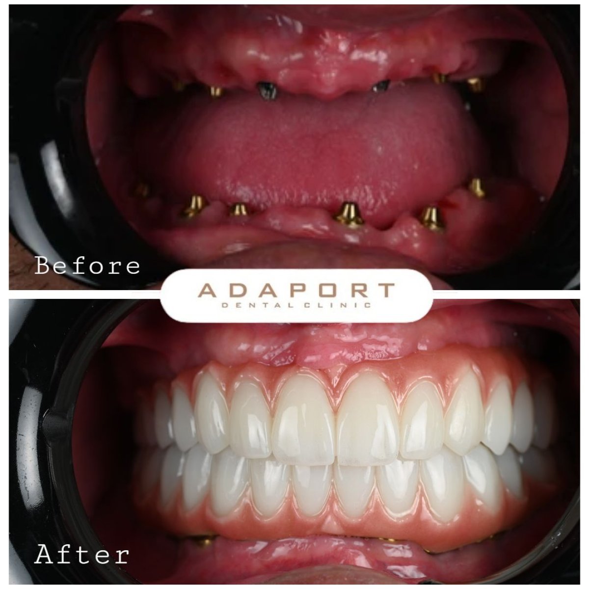 Resultados de implantes dentales All-on-4 antes y después en Adaport Dental Clinic, sonrisa restaurada