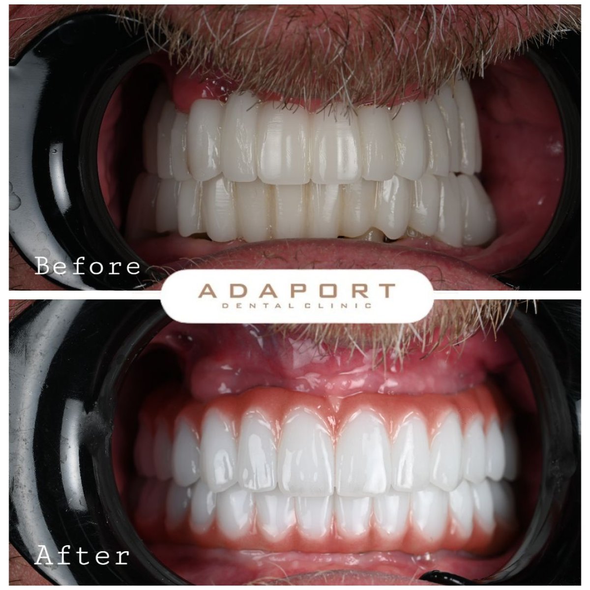 Resultados antes y después de implantes All-on-4 en Adaport Dental Clinic, sonrisa mejorada