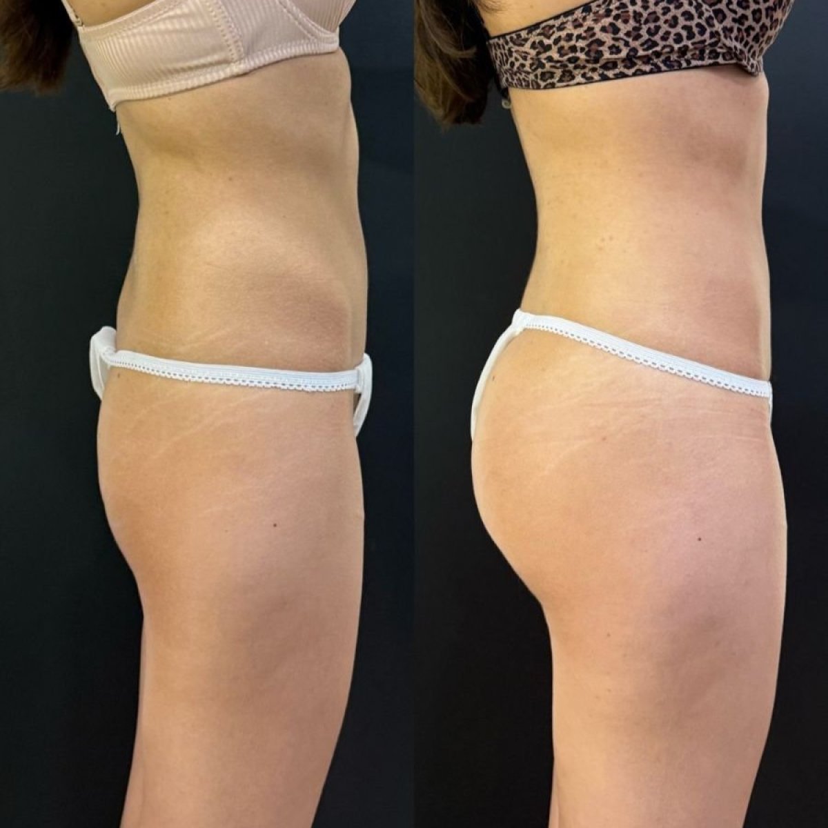 Antes y después de implantes de glúteos en Dr. Alexandro Aguilera - Plastic Surgery, mejor contorno