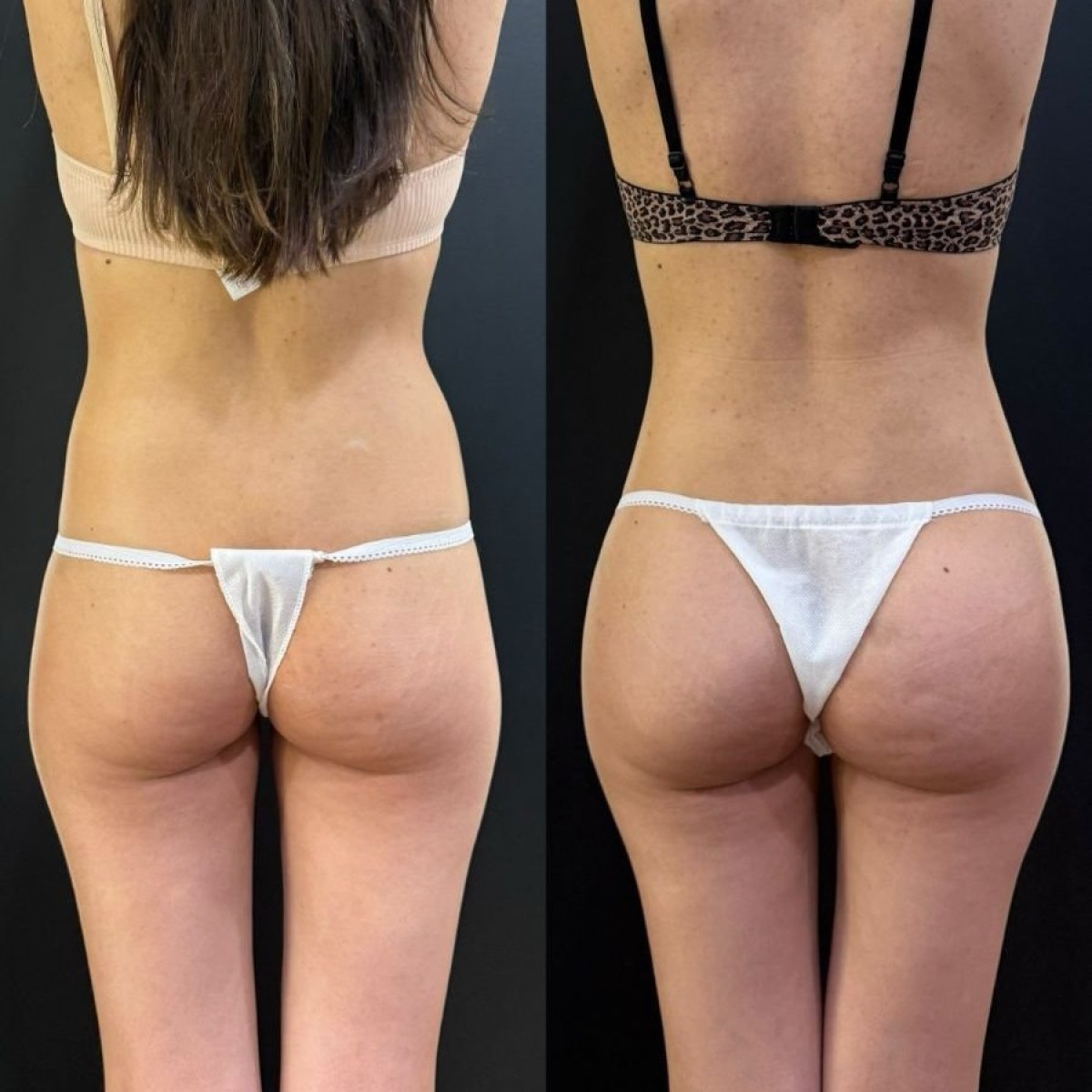 Vorher-nachher-Ergebnis Gesäßimplantate bei Dr. Alexandro Aguilera - Plastic Surgery, verbesserte Kontur