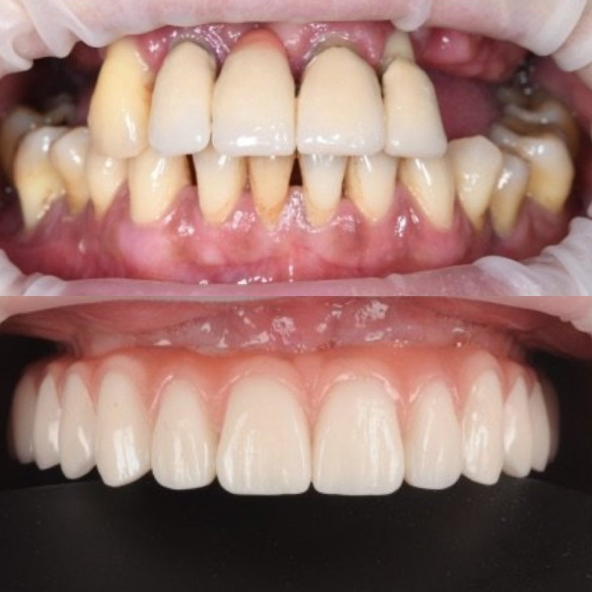 نتائج قبل وبعد تركيب طقم الأسنان في RIKOTA Dental Clinic – استعادة الابتسامة بالكامل