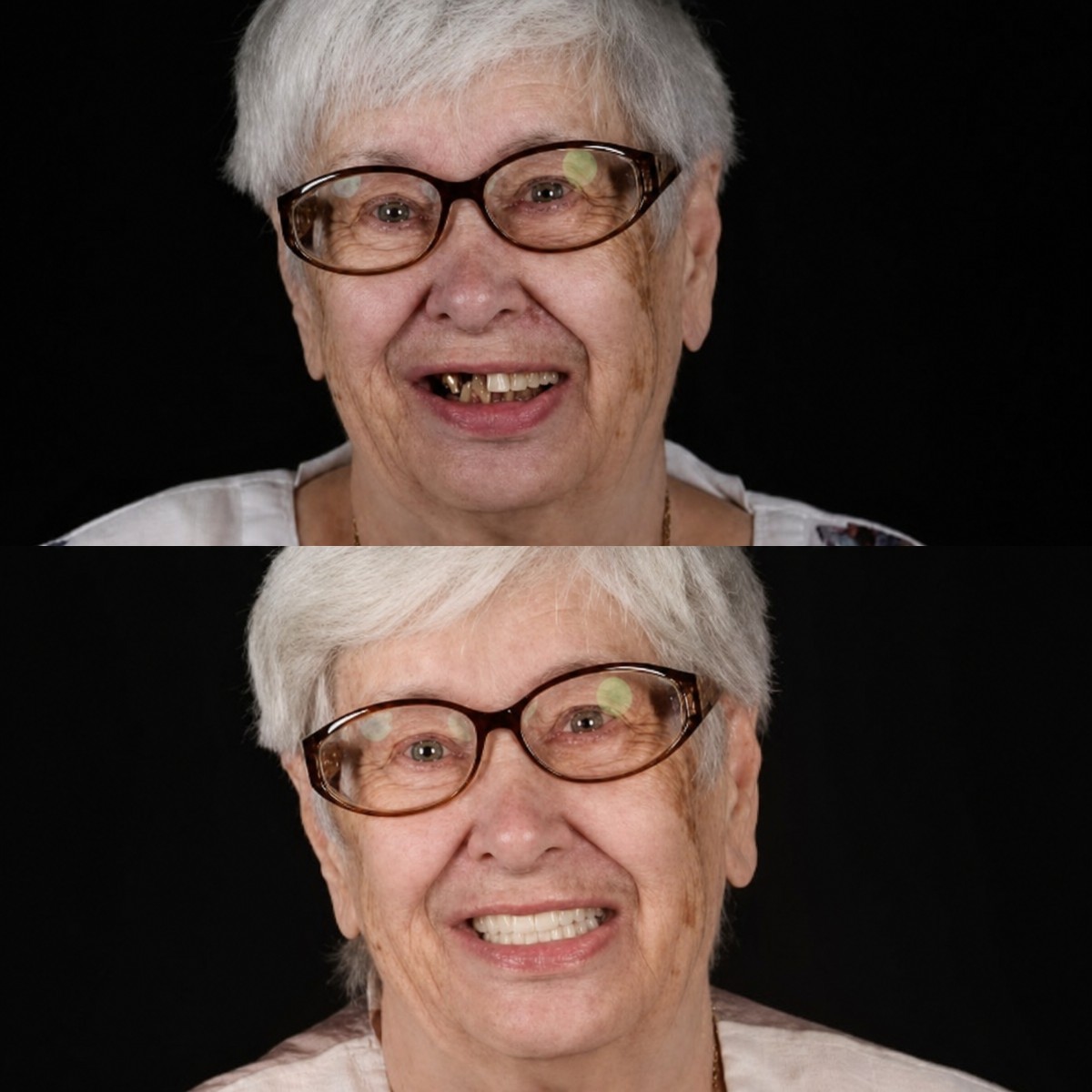 Resultados antes y después de implantes dentales en RIKOTA Dental Clinic: sonrisa restaurada