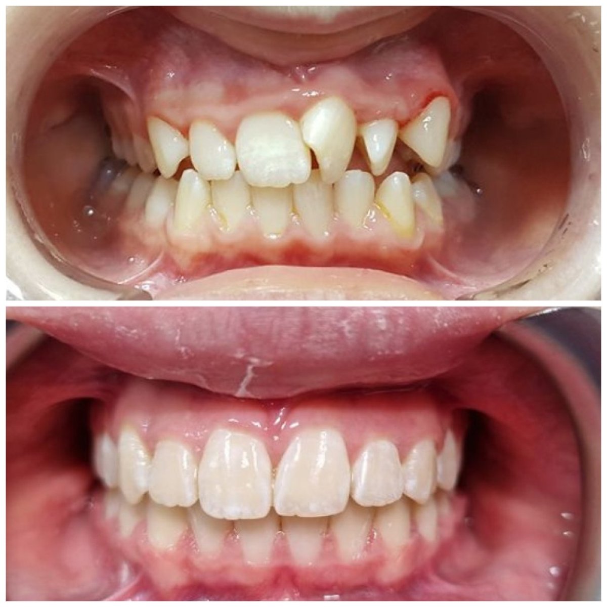 نتائج قبل وبعد تقويم الأسنان في عيادة Dental Clinic Dynasty Stomatology كراكوف، تحسين اصطفاف الأسنان