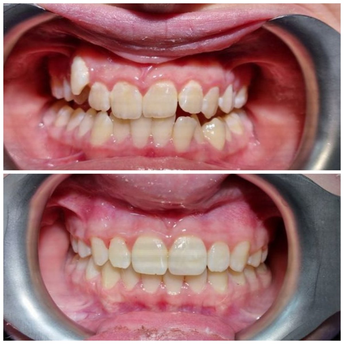 نتائج قبل وبعد تقويم الأسنان في عيادة Dental Clinic Dynasty Stomatology كراكوف، أسنان مستقيمة
