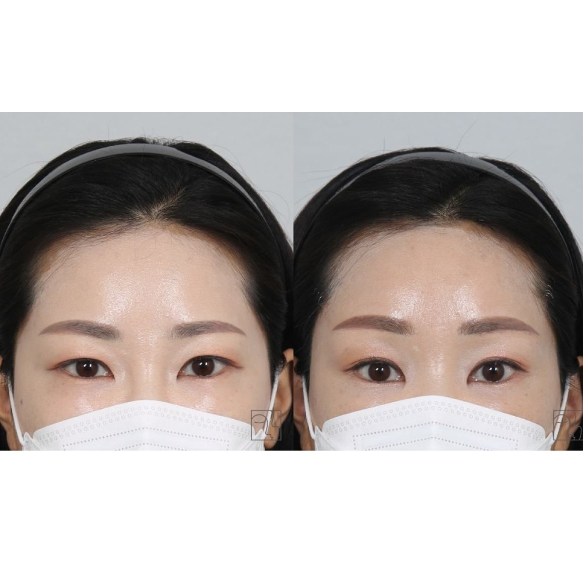 Forehead lift before and after results at Клиника пластической хирургии INIQUÉ, visible brow lift