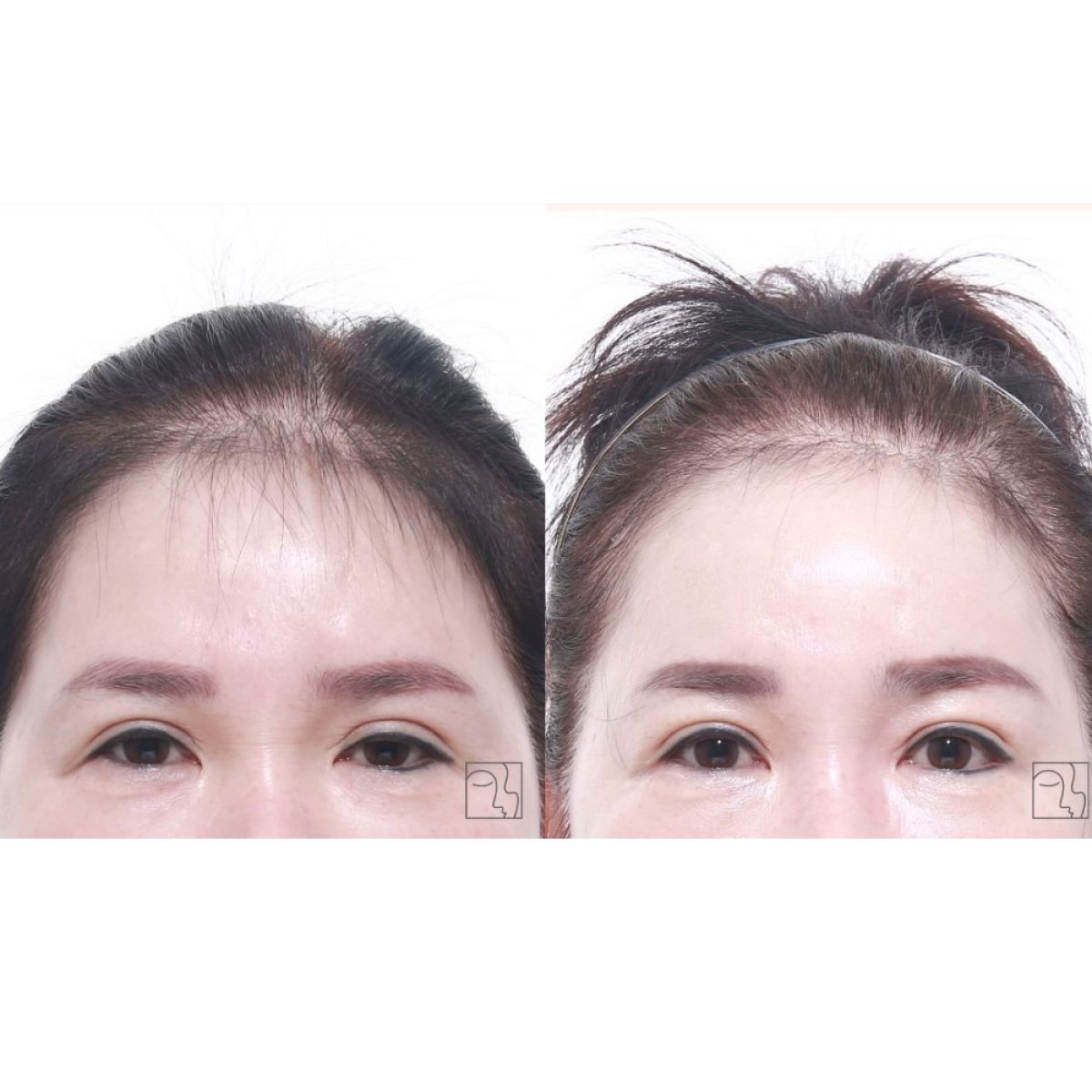 Forehead lift before and after results at Клиника пластической хирургии INIQUÉ, smoother brow