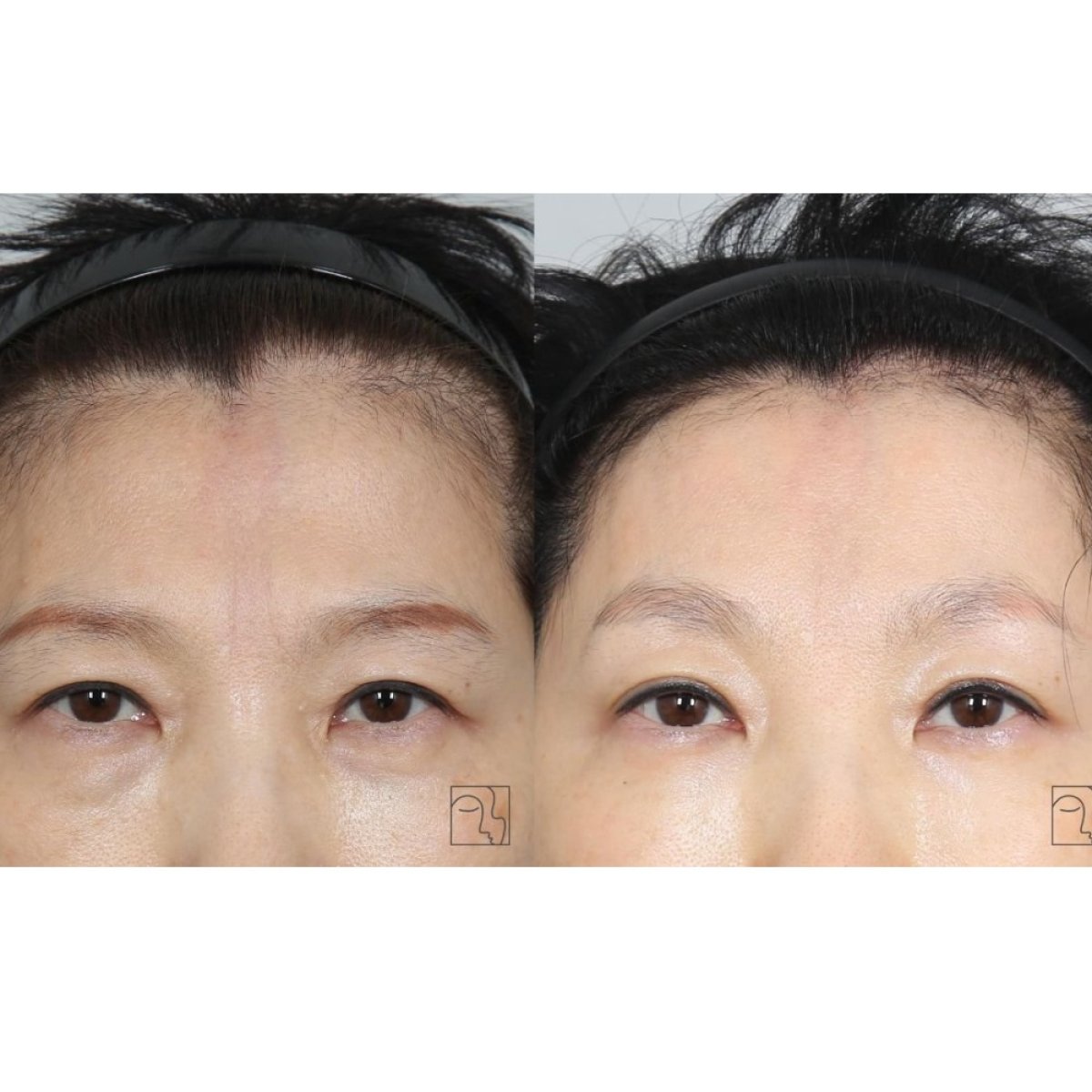 Forehead lift before and after results at Клиника пластической хирургии INIQUÉ, smoother brow