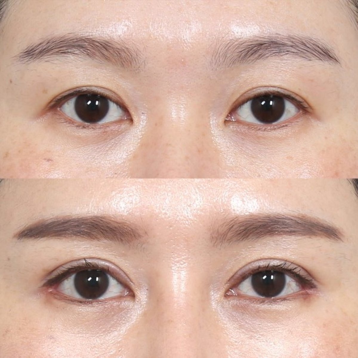 Résultats avant/après lifting des sourcils à Клиника пластической хирургии INIQUÉ