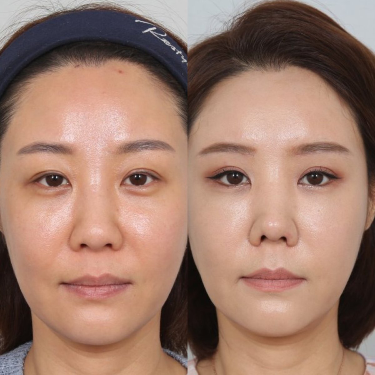Resultados antes y después de lifting de cejas en Клиника пластической хирургии INIQUÉ, rejuvenecimiento