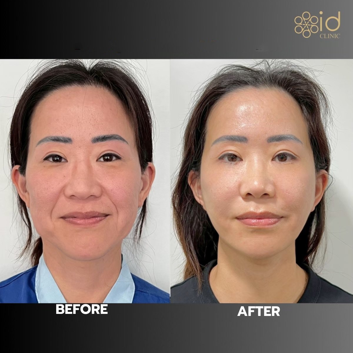 Before and after facelift results at ID Clinic Bangkok, visible facial rejuvenation and lift