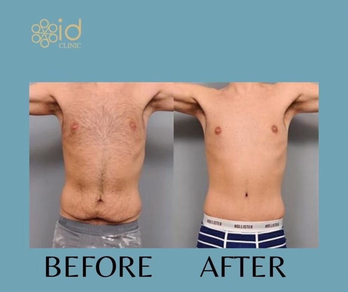 Before and after tummy tuck results at ID Clinic Bangkok, improved abdominal contour