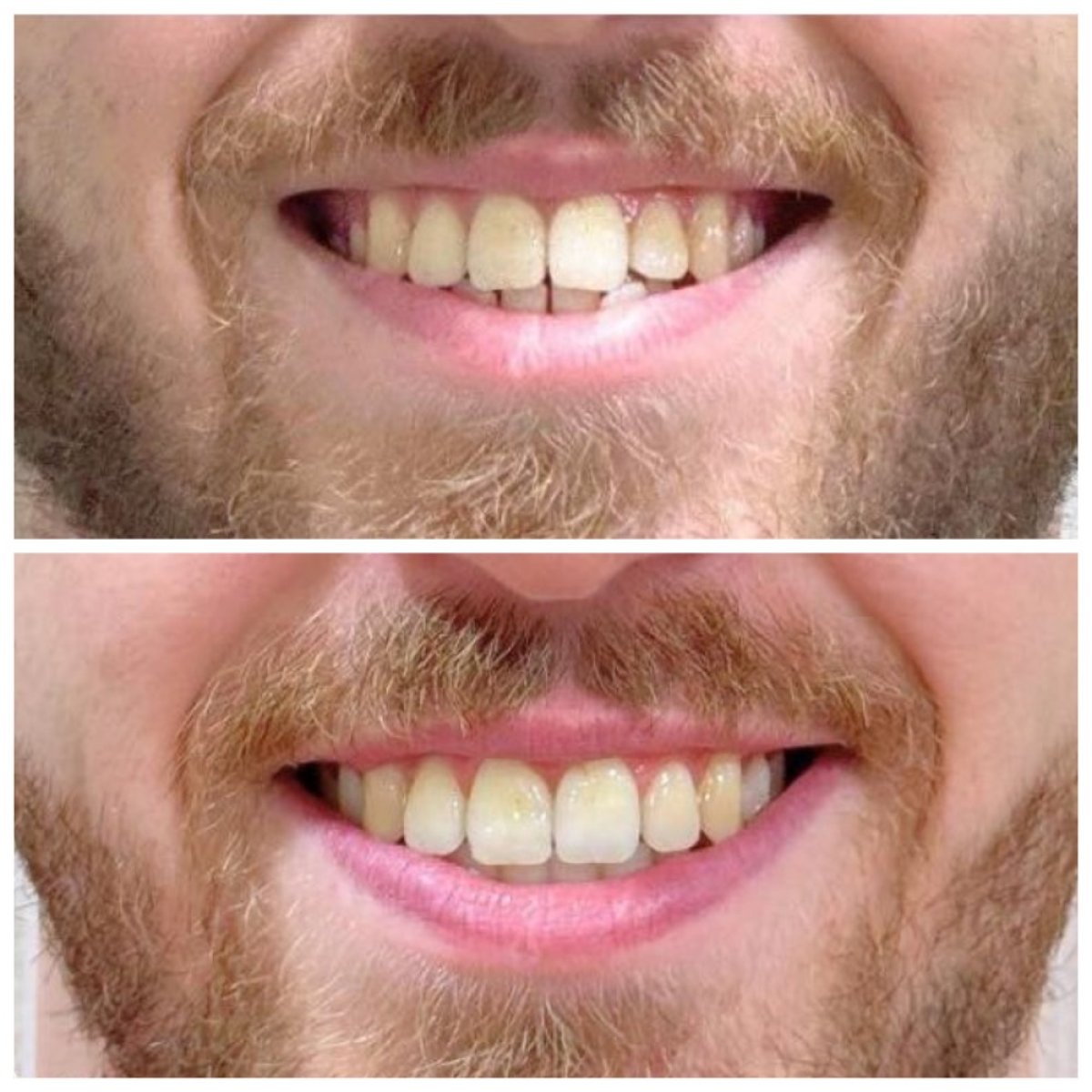Before and after Invisalign results at Dentist at home Clinic, Chonburi – straighter teeth