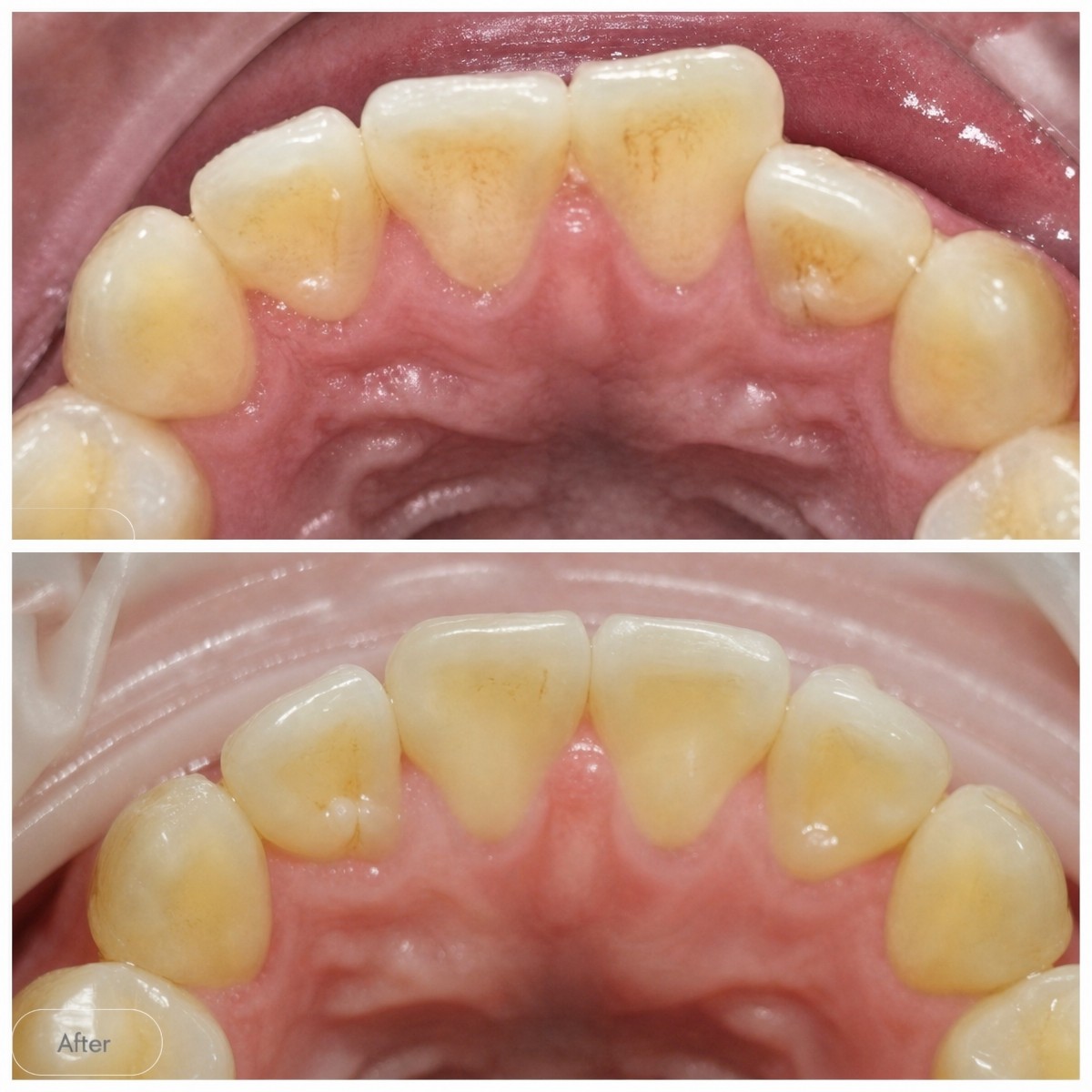 Before and after Invisalign results at Dentist at home Clinic, Chonburi, teeth alignment improvement
