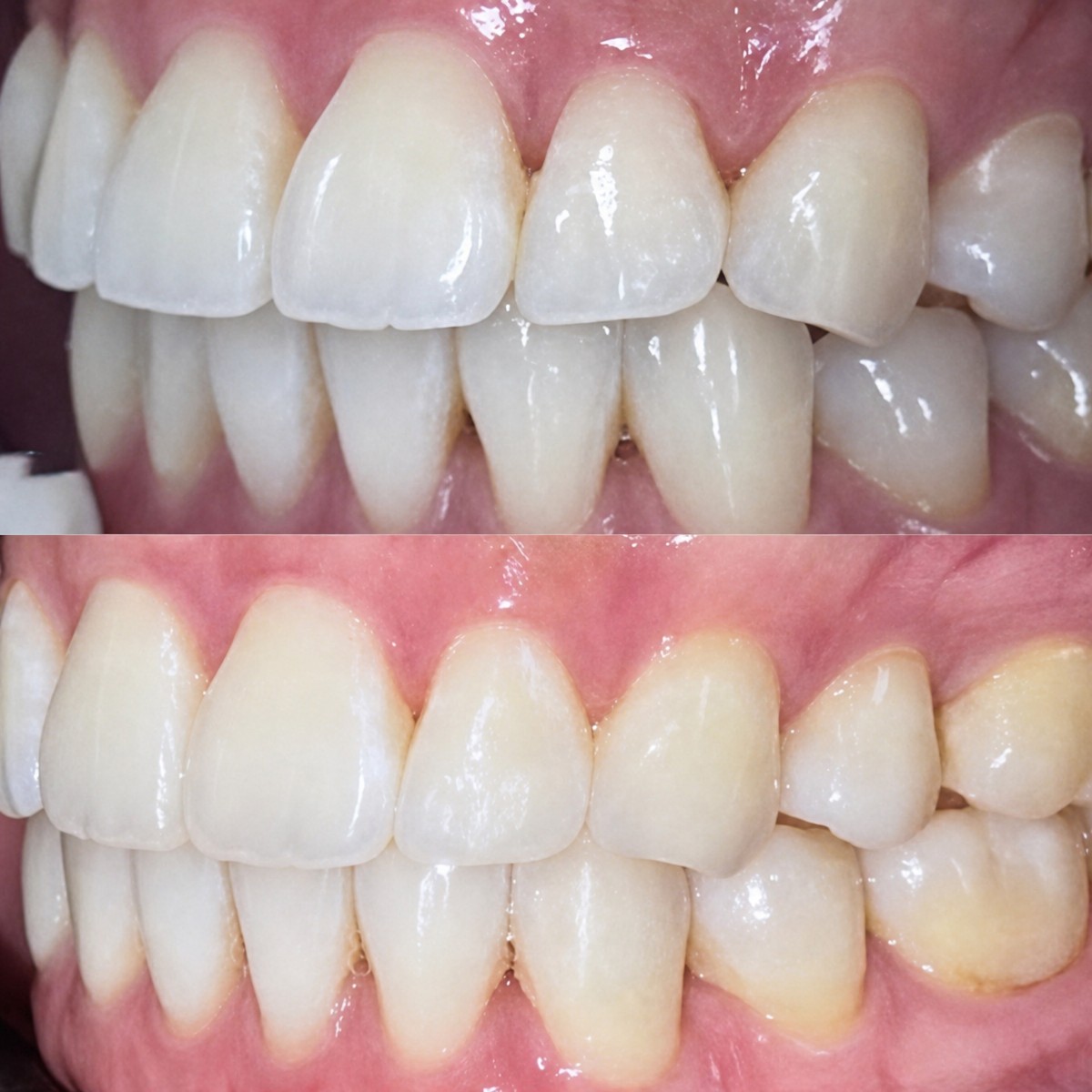 Before and after Invisalign results at Dentist at home Clinic, Chonburi – straighter teeth