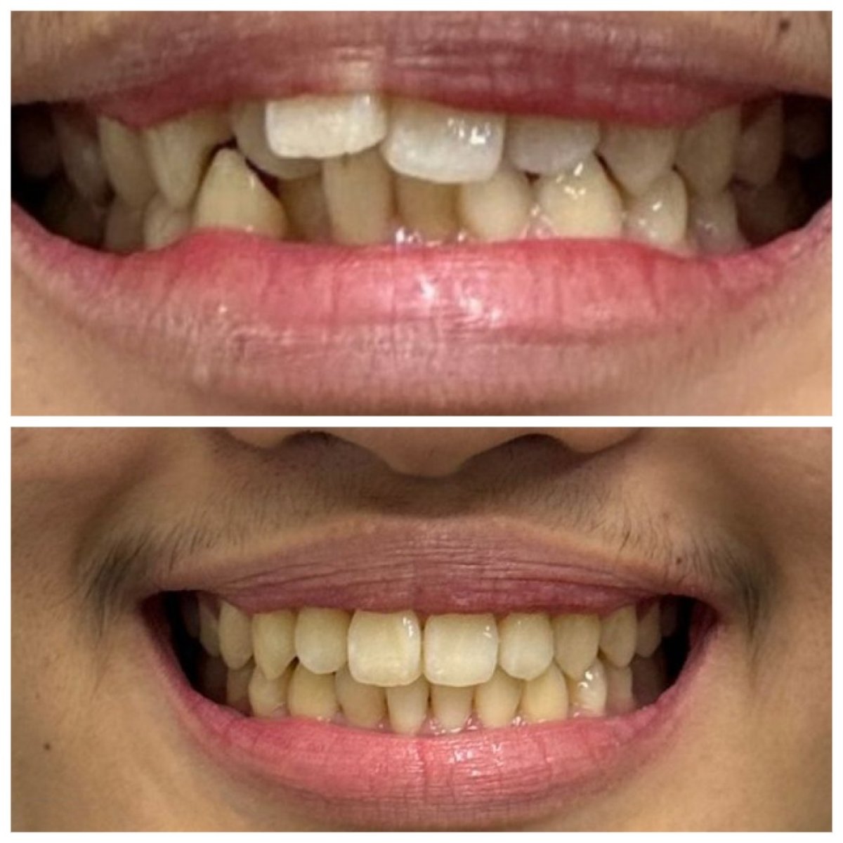 Efekty przed i po Invisalign w Dentist at home, Bangkok – prostsze ustawienie zębów