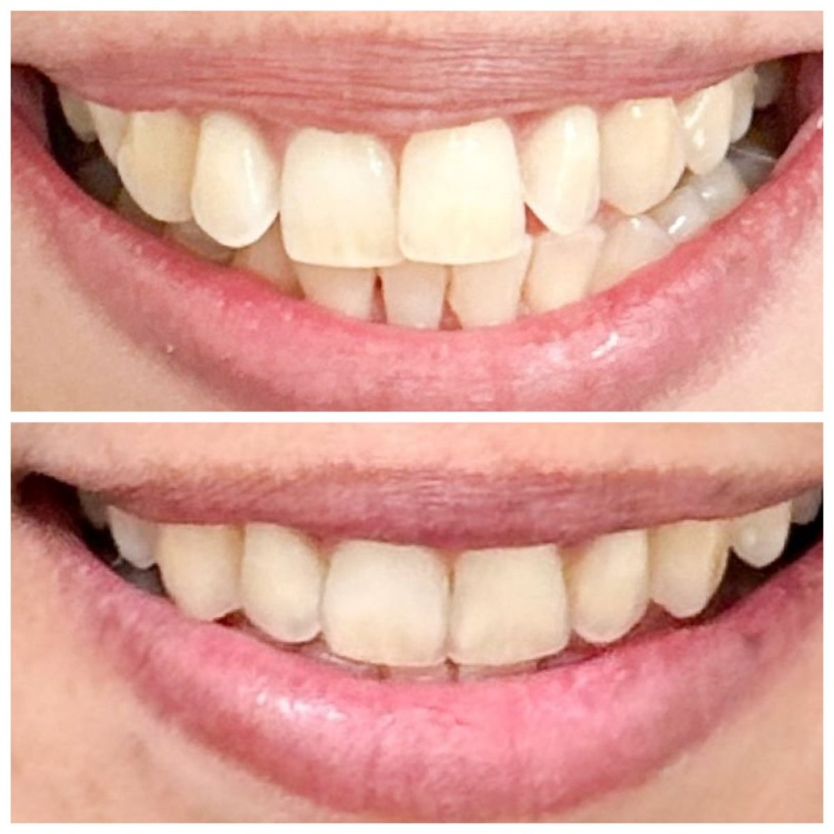 نتائج قبل وبعد تقويم Invisalign في عيادة Dentist at home، تشونبوري – أسنان أكثر استقامة