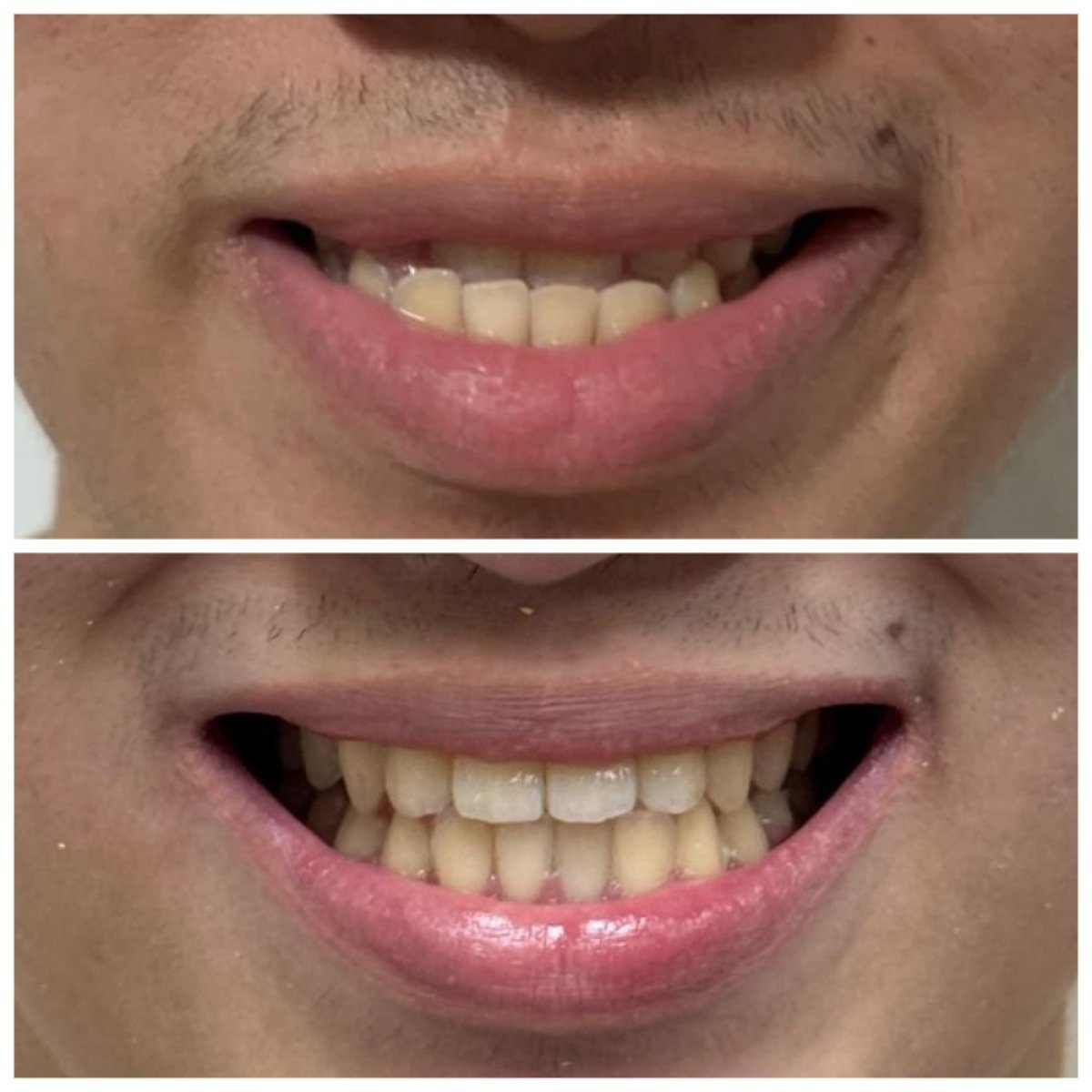 نتائج قبل وبعد تقويم Invisalign في عيادة Dentist at home، تشونبوري، أسنان مستقيمة