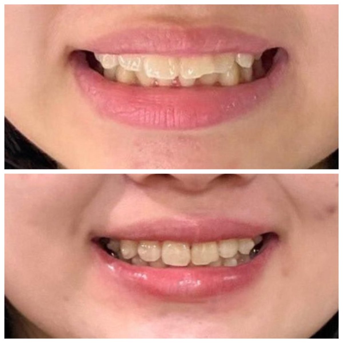 نتائج قبل وبعد تقويم Invisalign في عيادة Dentist at home، تشونبوري – أسنان أكثر انتظامًا