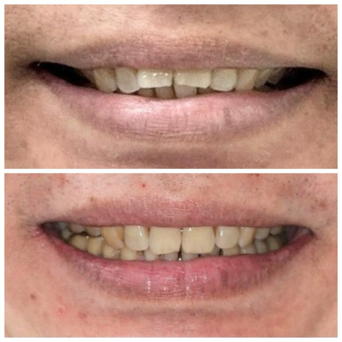 نتائج قبل وبعد تقويم Invisalign في عيادة Dentist at home، تشونبوري – أسنان أكثر استقامة