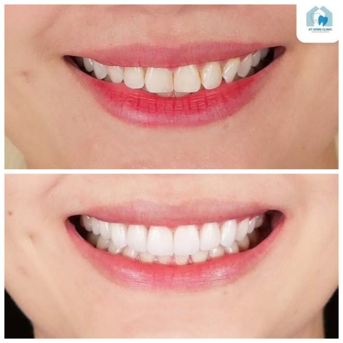 Resultado antes y después de carillas en Dentist at home Clinic, Chonburi – transformación de sonrisa