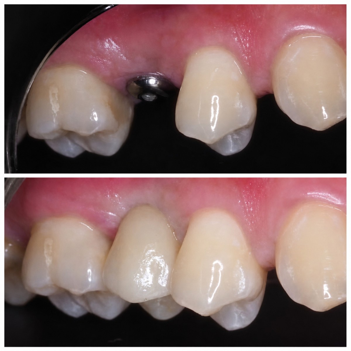نتيجة زراعة الأسنان قبل وبعد في عيادة Dentist at home، تشونبوري، استعادة السن