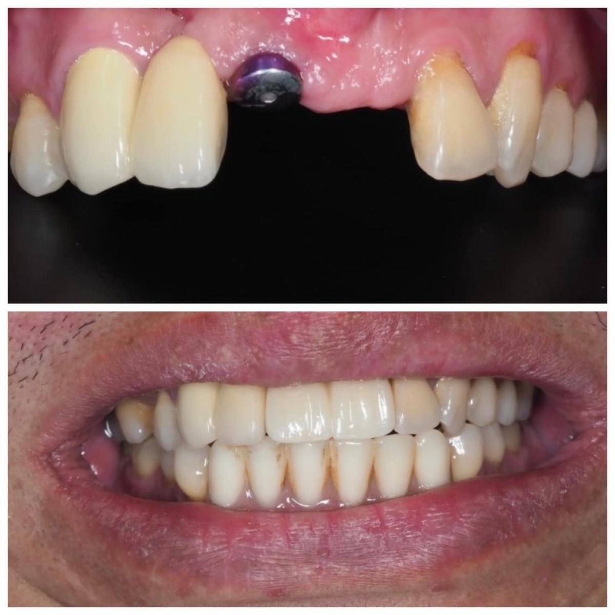 Результаты до и после имплантации зубов в Dentist at home Clinic, Чонбури – восстановленная улыбка