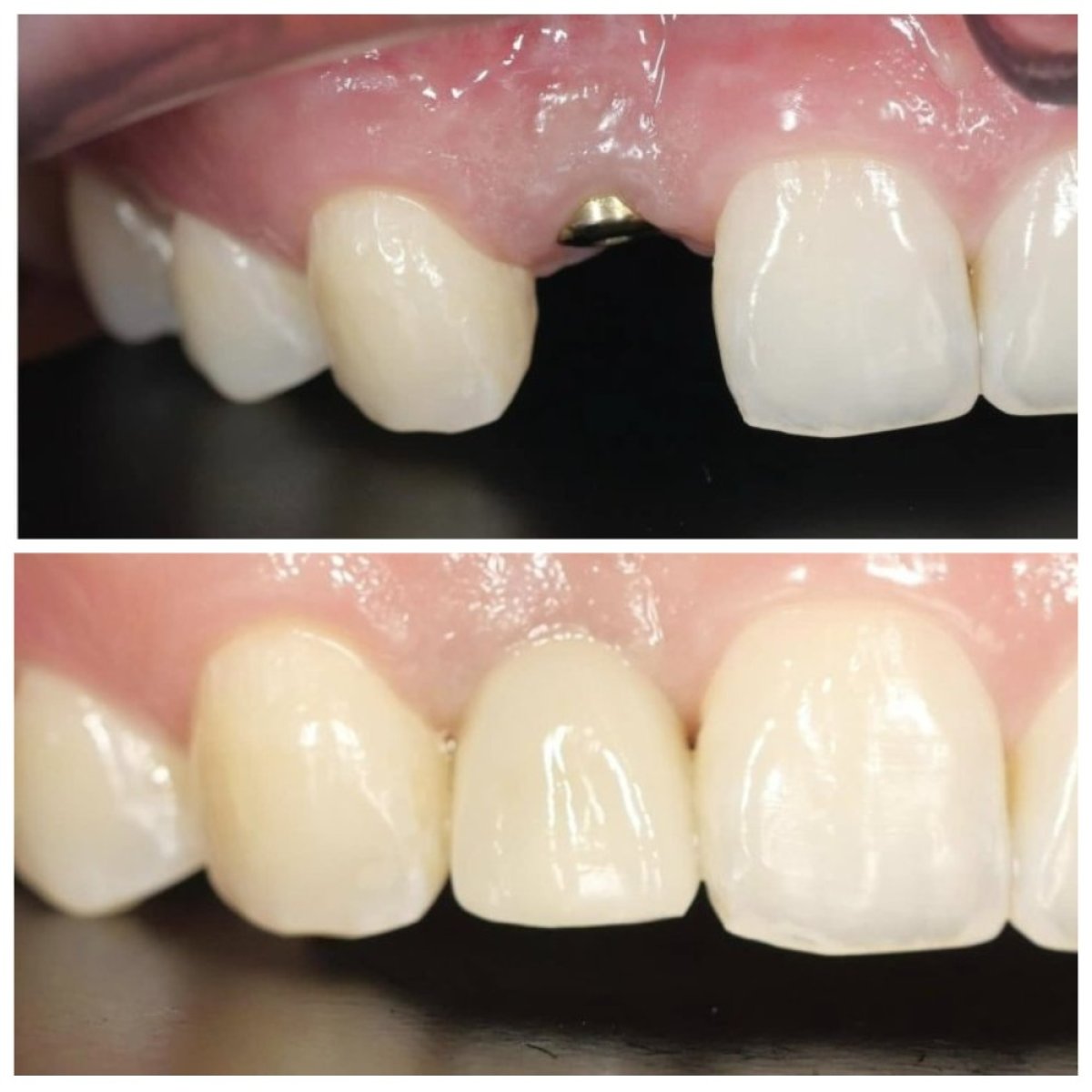 Результати до і після імплантації зуба в Dentist at home Clinic, Chonburi, відновлений передній зуб