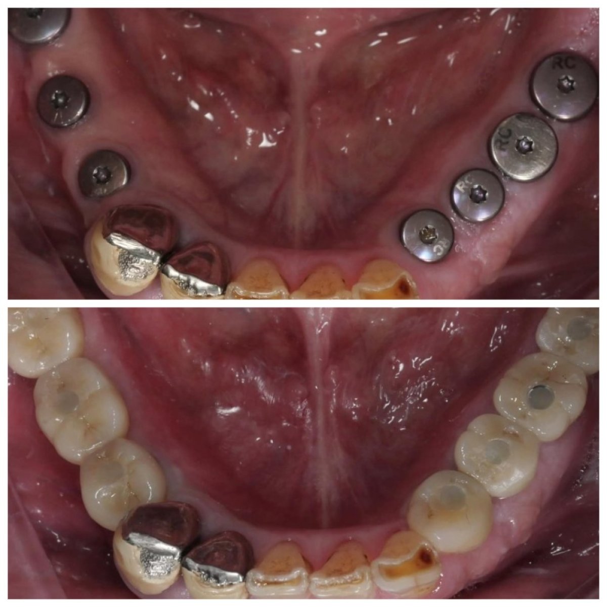 Before and after dental implant results at Dentist at home Clinic, Chonburi – restored lower teeth
