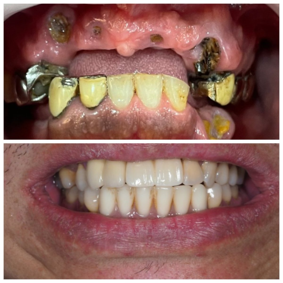 Résultat avant/après implants All-on-4 à Dentist at home Clinic, Chonburi