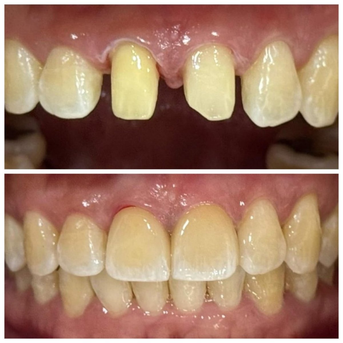 Résultats avant et après pose de couronnes dentaires à Dentist at home Clinic, Chonburi