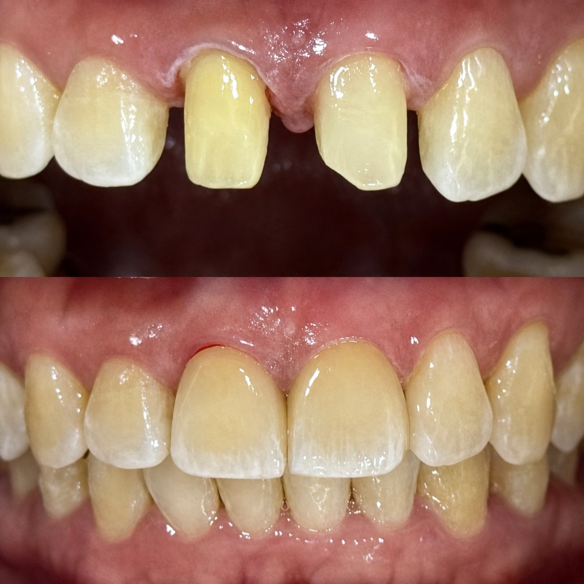 نتائج قبل وبعد تركيب تيجان الأسنان في Dentist at home بانكوك، ابتسامة محسنة