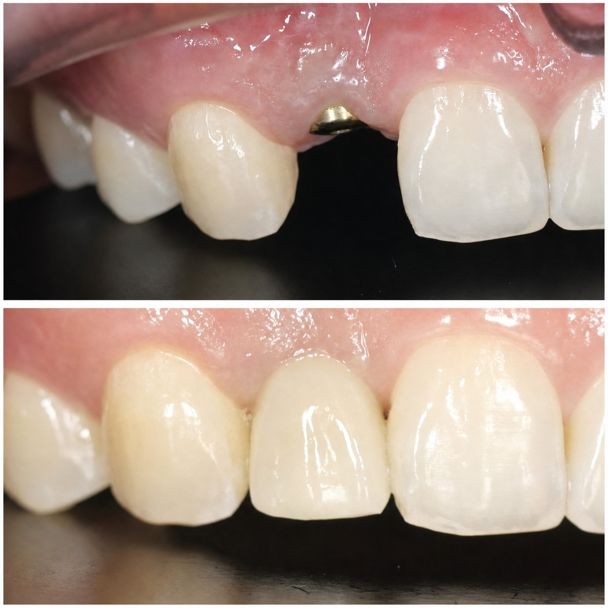 Vorher-nachher-Ergebnis Zahnkronen bei Dentist at home Clinic, Chonburi