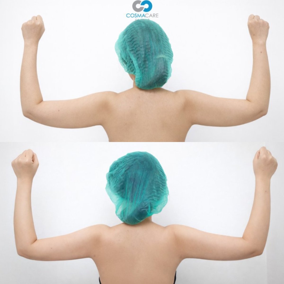 Before and after arm liposuction results at Cosmacare clinic – improved arm contour
