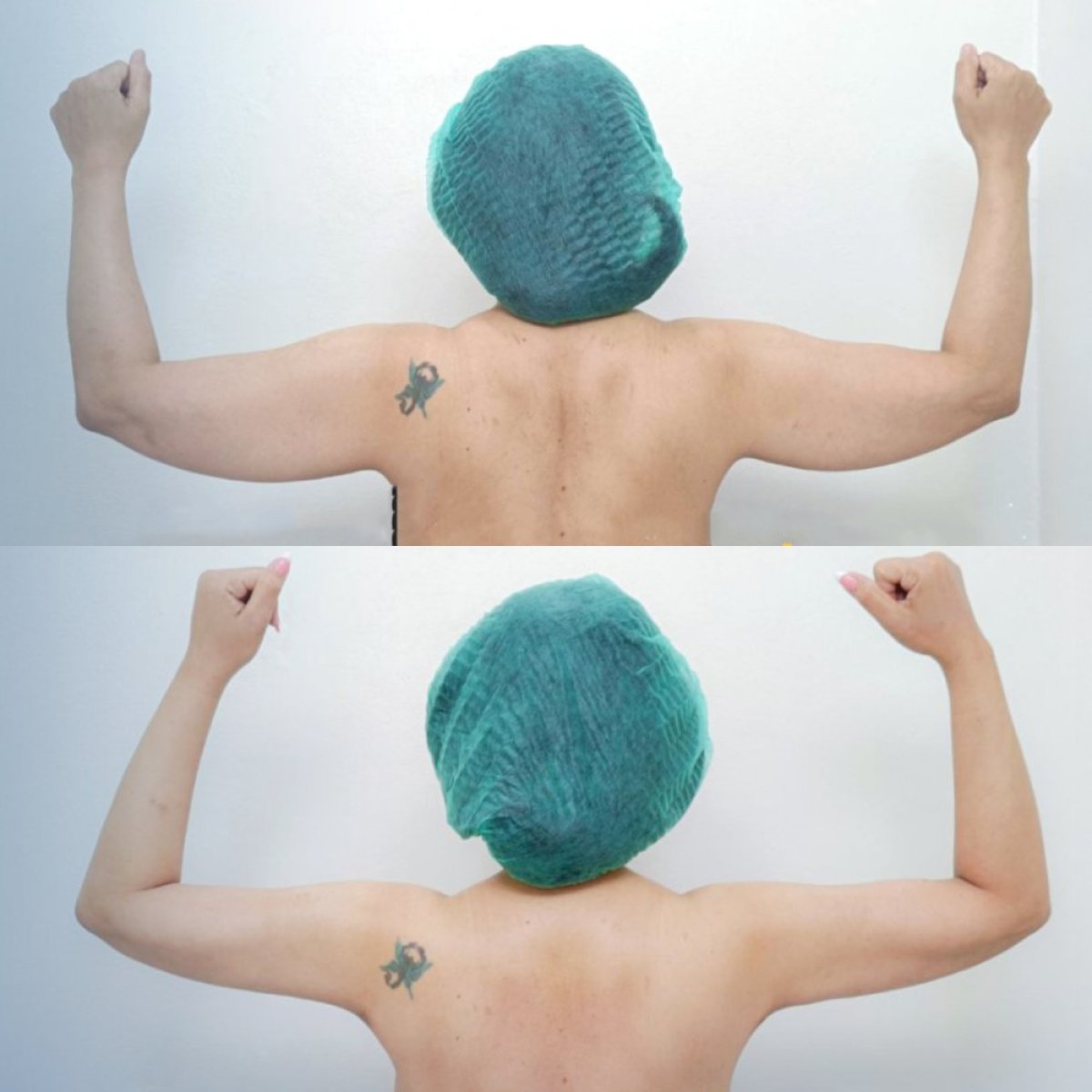 Before and after arm liposuction results at Cosmacare clinic – improved arm contour visible