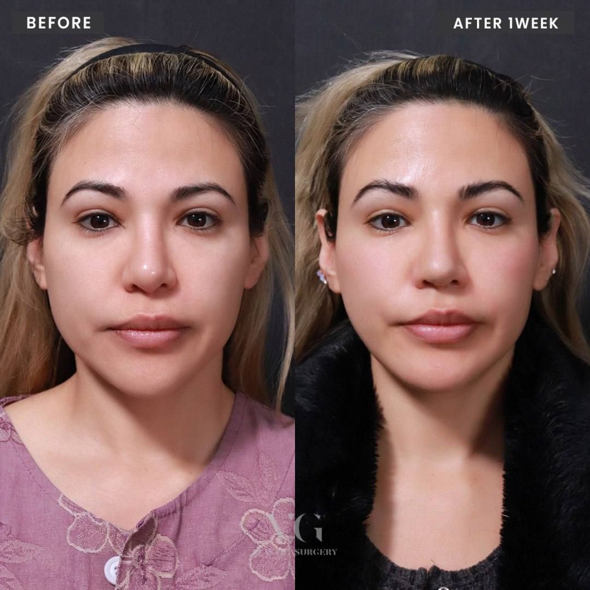 Результаты до и после подтяжки лба в VG Plastic Surgery, видимый лифтинг бровей через 1 неделю