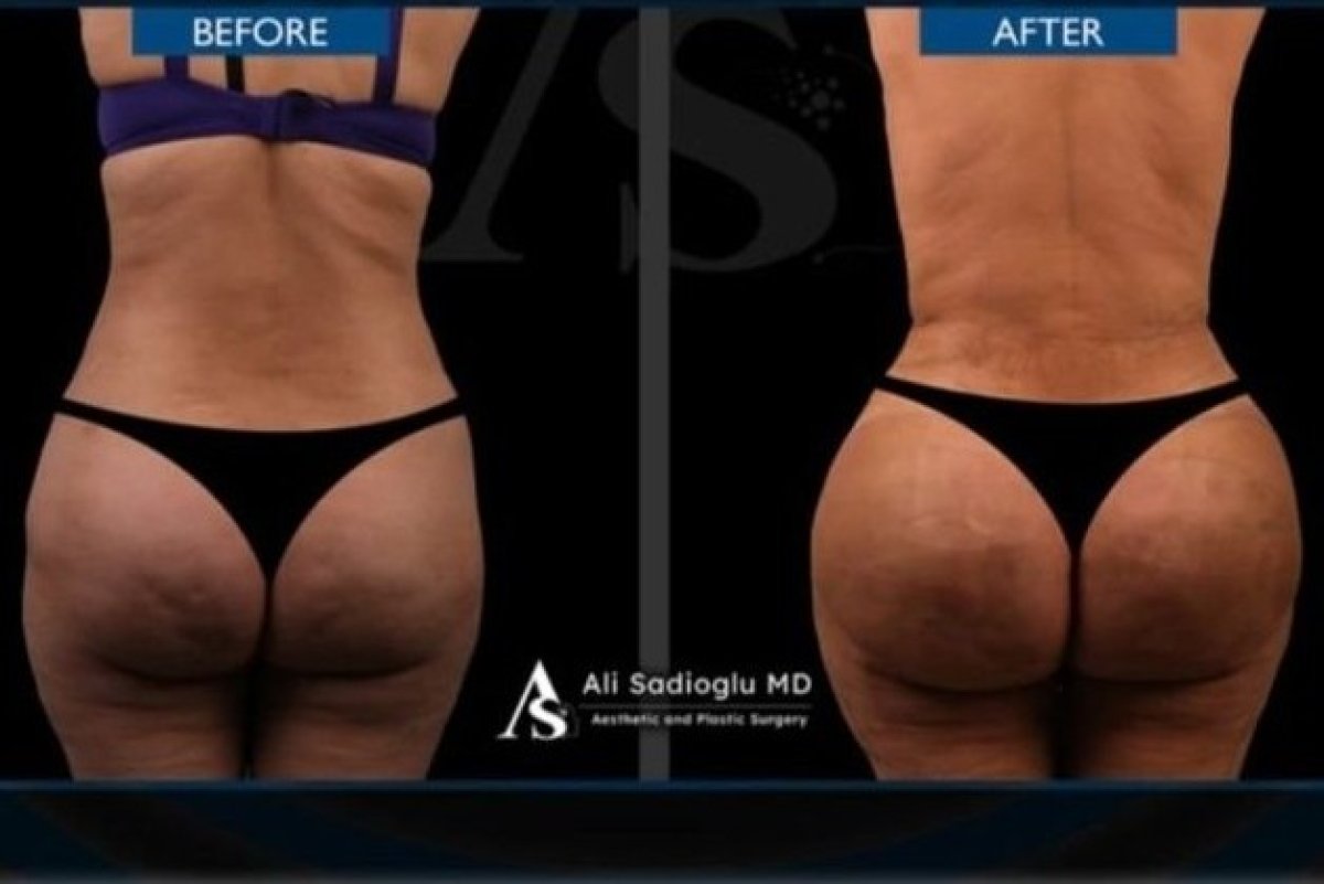 Before and after Brazilian Butt Lift results at Dr. Safa Manav Clinic, enhanced buttock contour