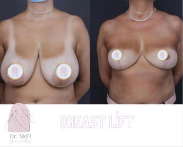 Breast Augmentation + Lift with Mentor Implants — 5 Nights at Hotel Included - photo 5