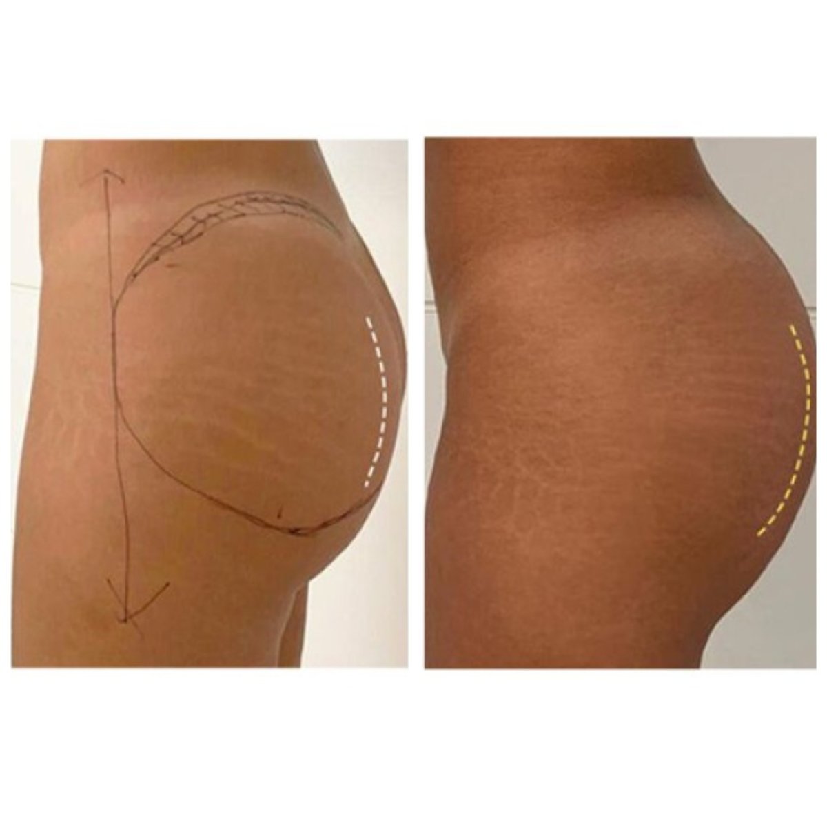 Before and after butt implants at Klinika La Perla, enhanced gluteal contour results