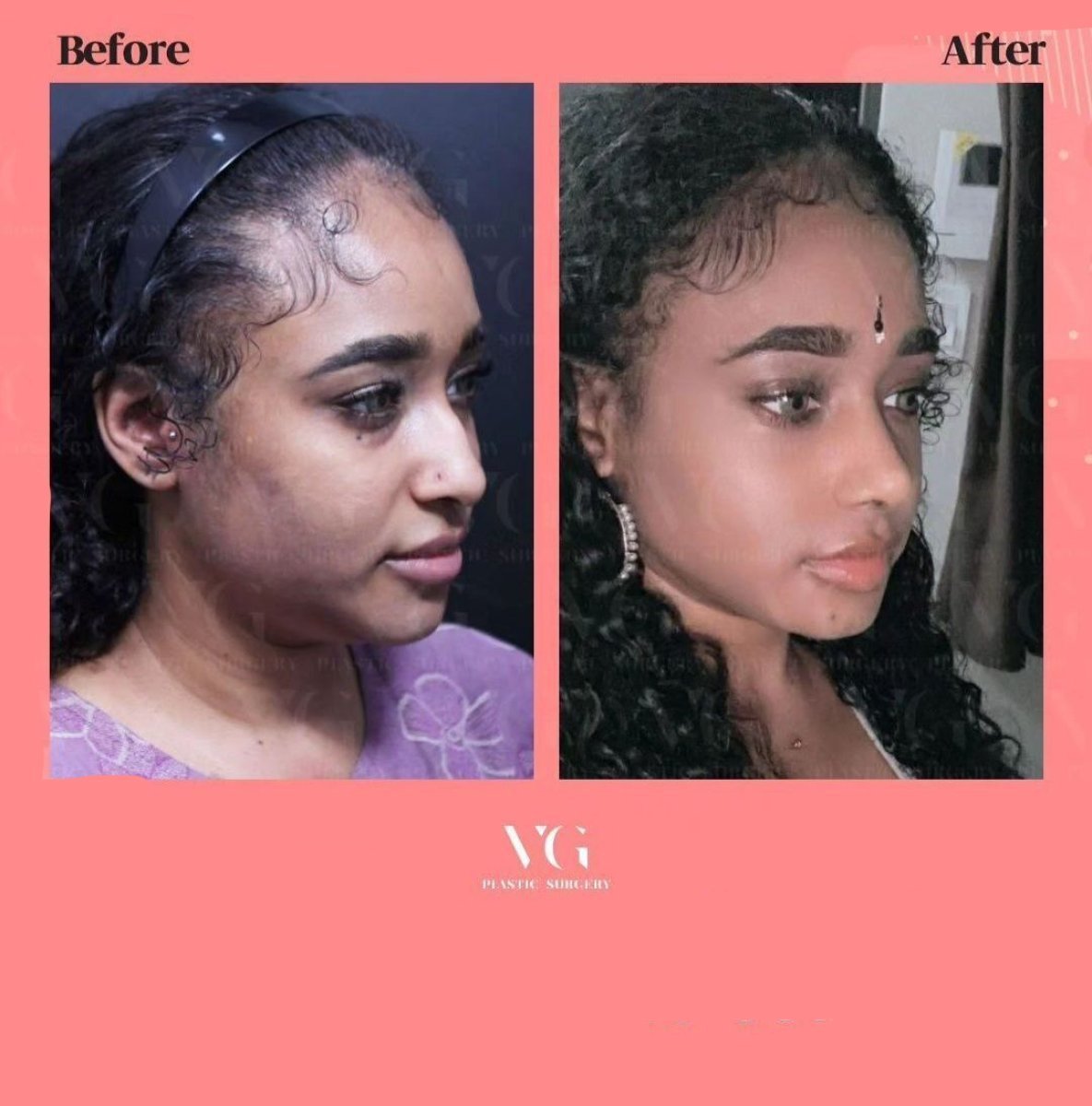 نتائج قبل وبعد عملية تصغير فتحات الأنف في VG Plastic Surgery، تحسين شكل الأنف