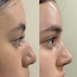 Fotos vor und nach Rhinoplastik (Nasenkorrektur) durch Dr. 