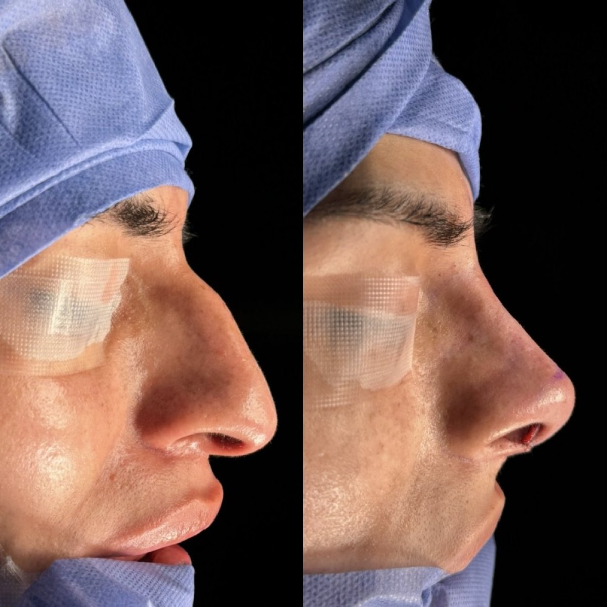 Résultats avant/après rhinoplastie, remodelage du nez et profil amélioré en clinique