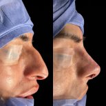 Fotos vor und nach Rhinoplastik (Nasenkorrektur) durch Dr. 