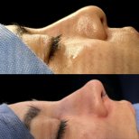 Fotos vor und nach Rhinoplastik (Nasenkorrektur) durch Dr. 