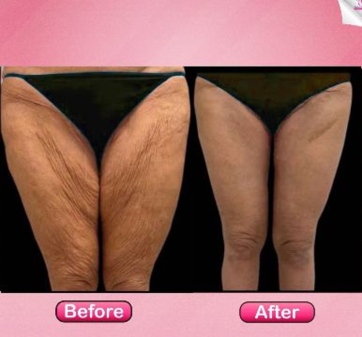 Résultats avant et après liposuccion des cuisses à la clinique Somchai, contour amélioré
