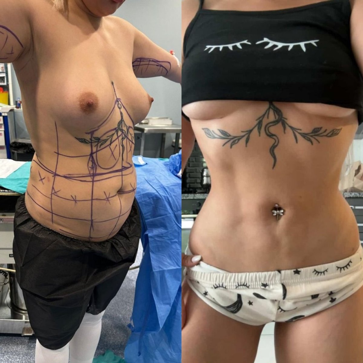 Résultats avant et après liposuccion à Memorial Bahçelievler Hospital, silhouette affinée